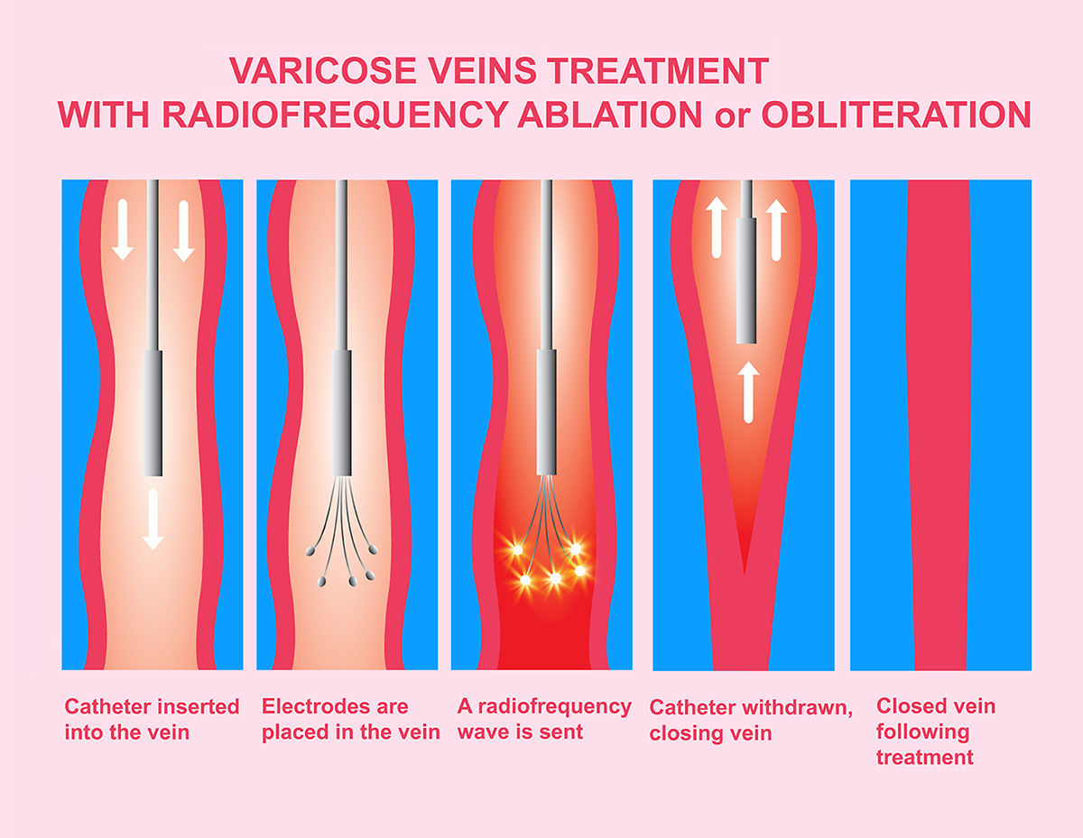 How to get rid of varicose veins on your legs