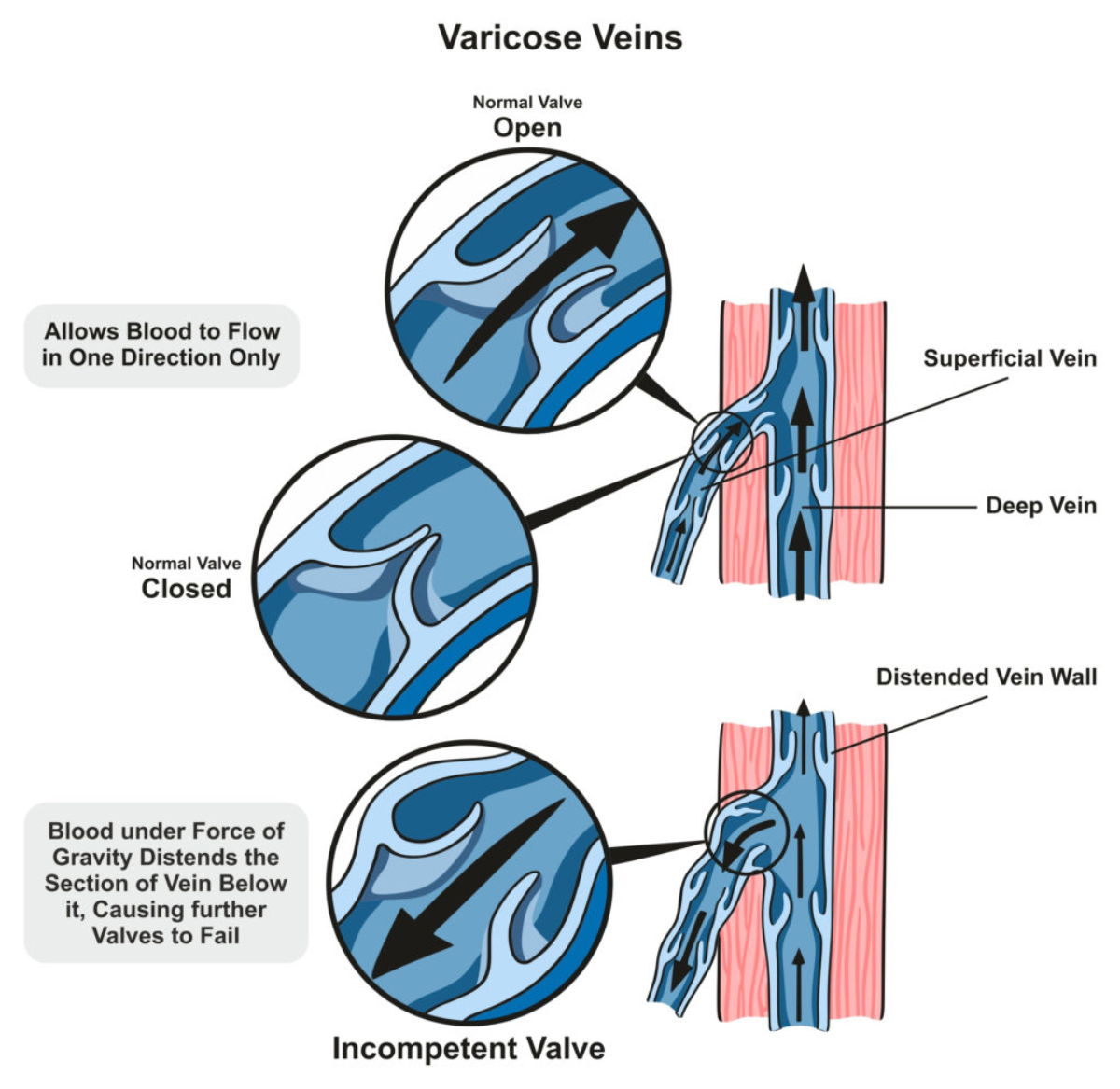 The truth about home remedies for varicose veins